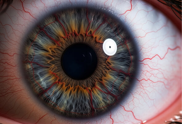What causes red veins in eyes